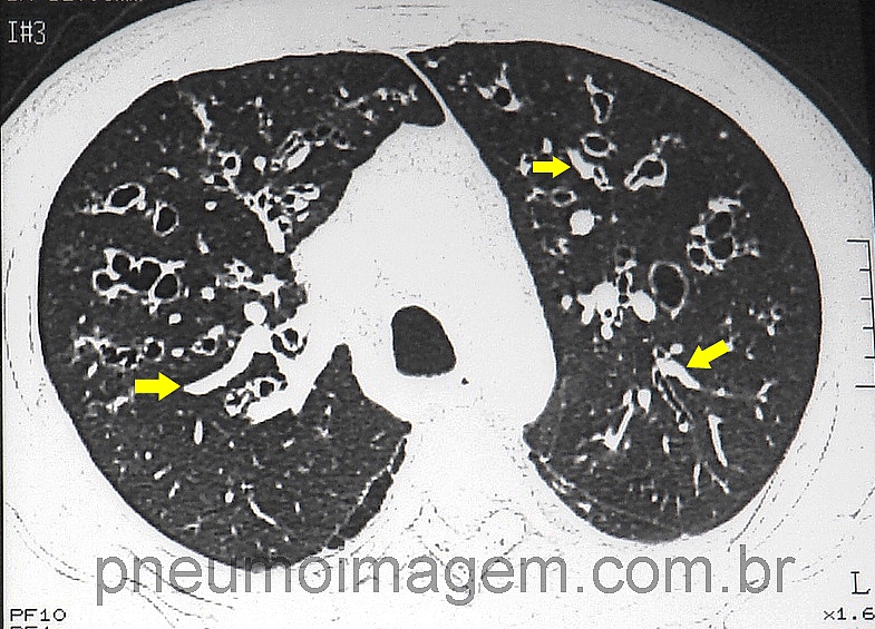 DESTAQUES DO CHEST 2015: ATUALIZAÇÃO EM ASPERGILOSES PULMONARES DESTAQUES DO CHEST 2015: ATUALIZAÇÃO EM ASPERGILOSES PULMONARES